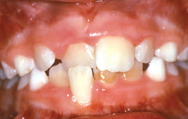 Crossbite Sorensen Orthodontics in West Seattle, WA