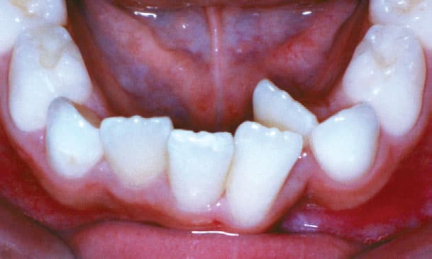 Crowding Sorensen Orthodontics in West Seattle, WA