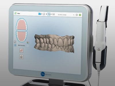 iTero Digital Impressions Sorensen Orthodontics in West Seattle, WA