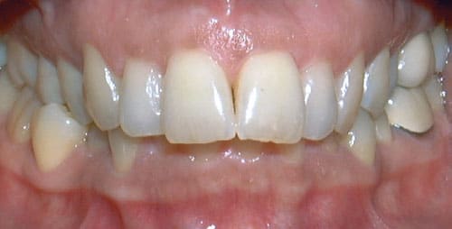 Overbite Sorensen Orthodontics in West Seattle, WA
