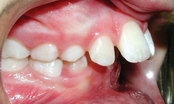 Protrusion Sorensen Orthodontics in West Seattle, WA