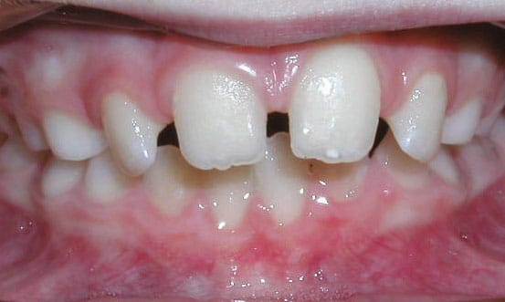 Spacing Sorensen Orthodontics in West Seattle, WA