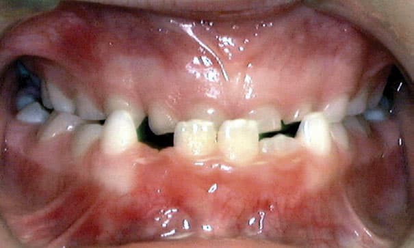 Underbite Sorensen Orthodontics in West Seattle, WA